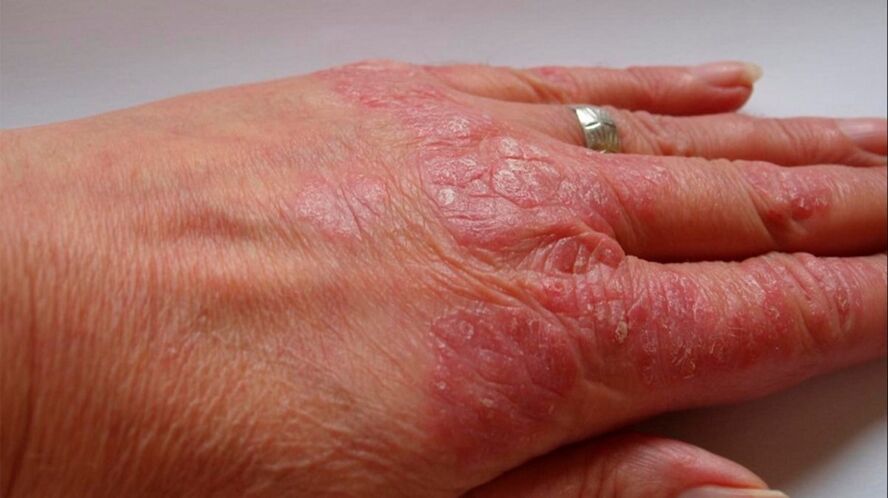 psoriasis symptoms on the hands