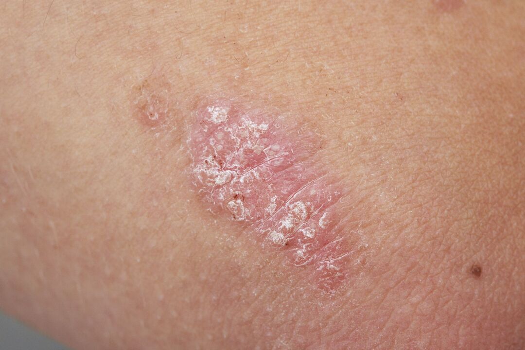 psoriasis on the skin of a child