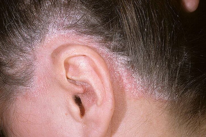 Eruptions of psoriasis on the head behind the ears