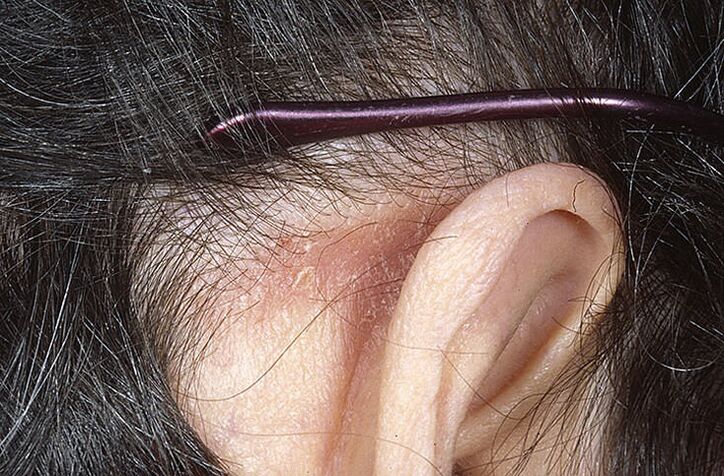 Psoriatic plaque behind the ear
