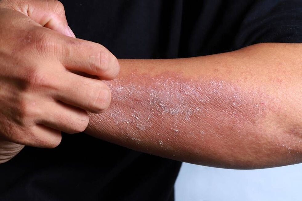 skin psoriasis symptoms