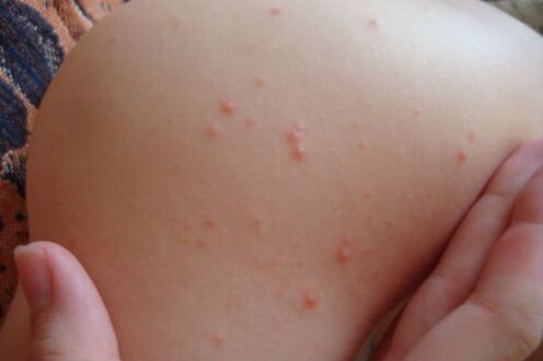 body psoriasis symptoms