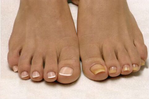 psoriasis on nails