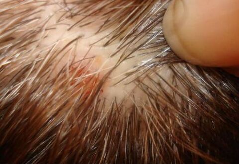 psoriasis on the scalp