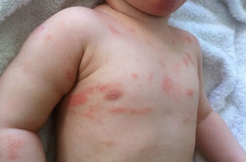 symptoms of psoriasis in a child