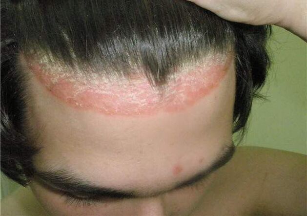crown of psoriasis on head