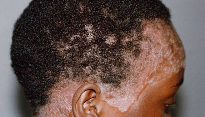 Psoriasis on the head