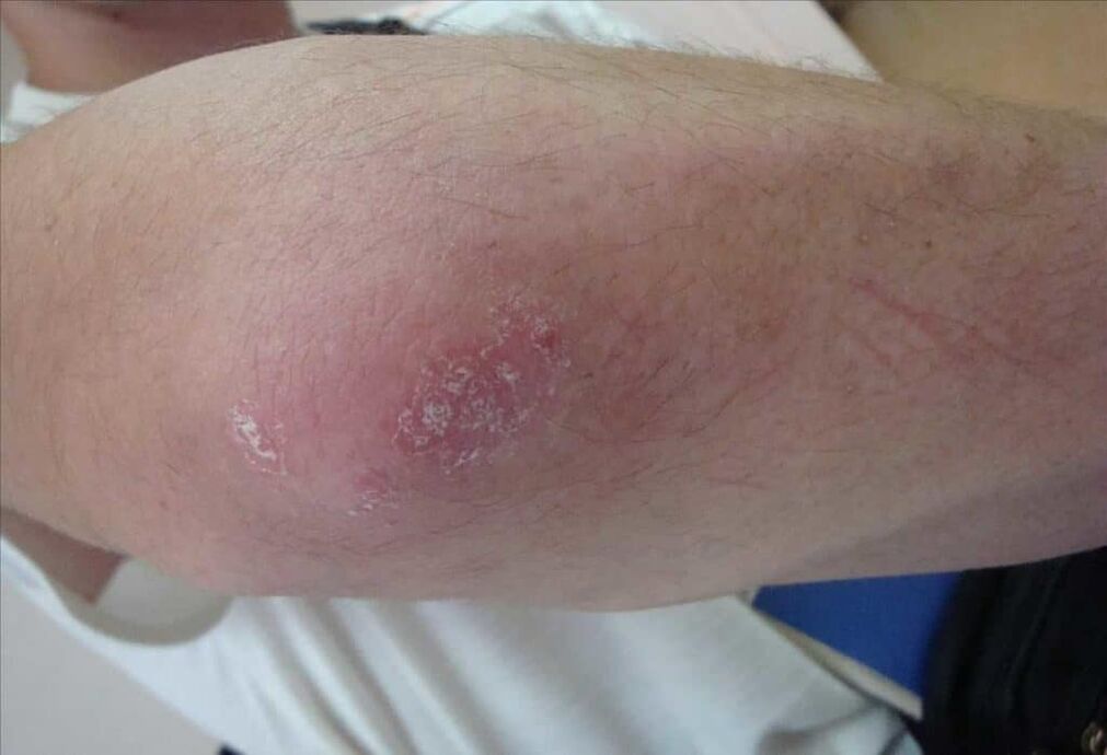 What psoriasis looks like