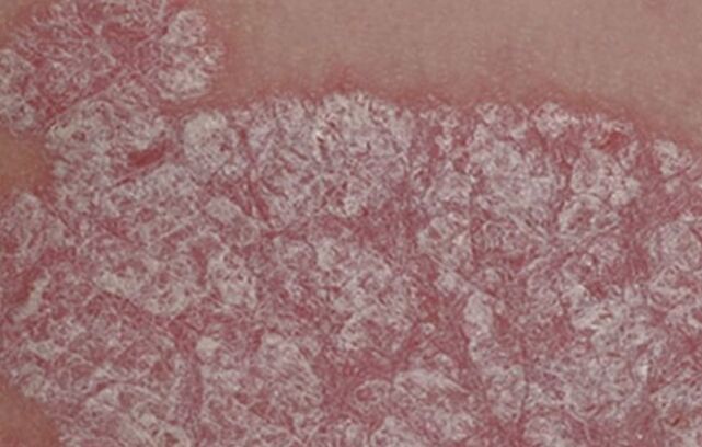 Healing of papules