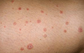 Psoriatic plaques