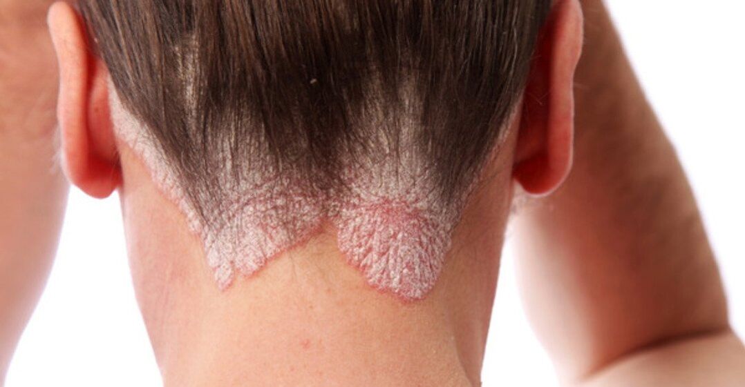 Psoriasis on the head of girls