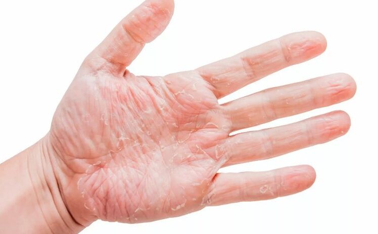 Psoriasis