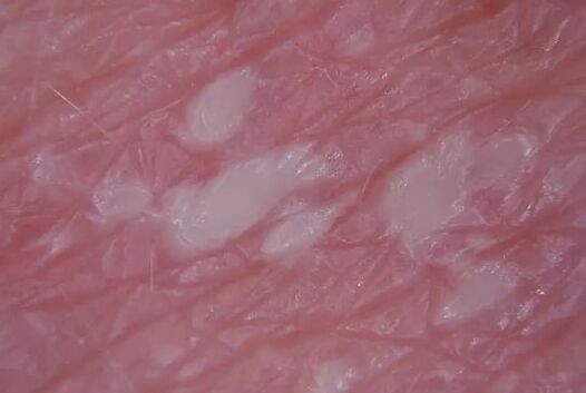 Pustulenia psoriasis