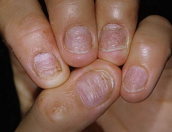 Psoriasis of nails