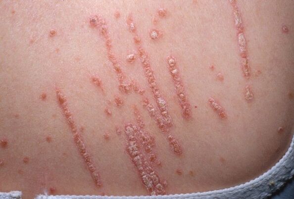 Psoriasis on the body