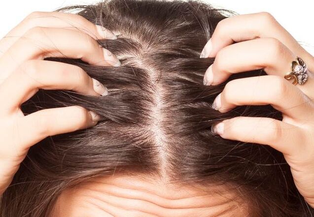 Psoriasis on the head