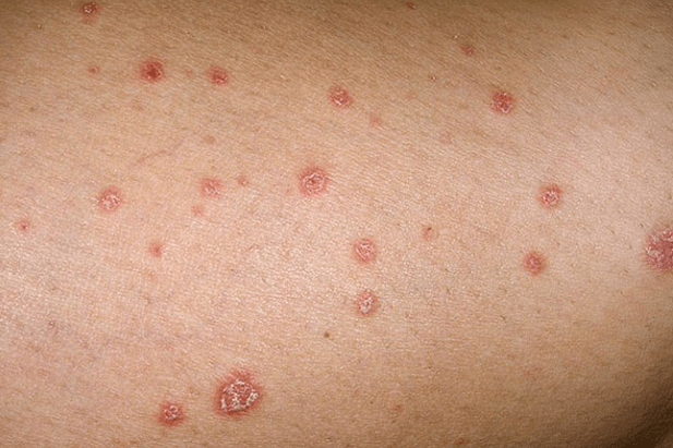 Psoriatic plaques