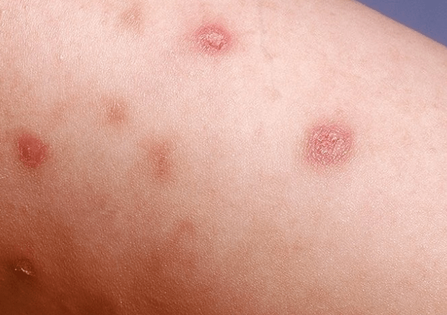 Initial stage of psoriasis