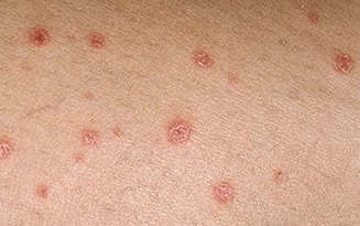 Psoriasis at the very beginning stage