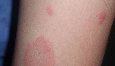 How does the initial stage of psoriasis manifest