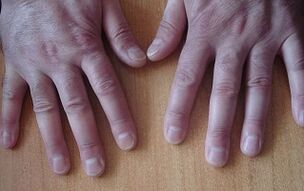symptoms of psoriasis at the initial stage