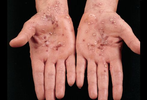 what does psoriasis look like on the palms of the hands