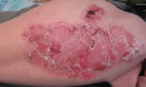 what does pustular psoriasis look like on the skin