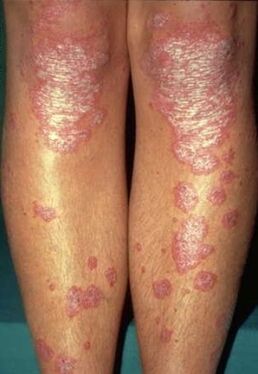 Manifestations of psoriasis on the legs