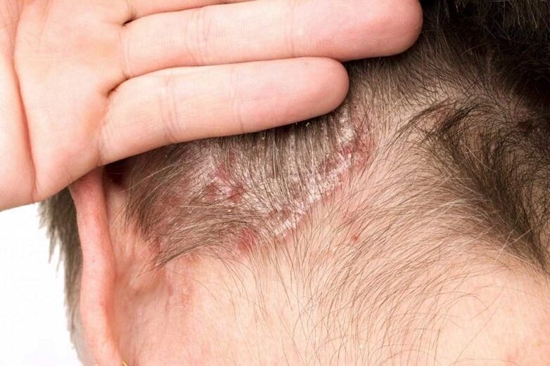 photo of psoriasis on the head
