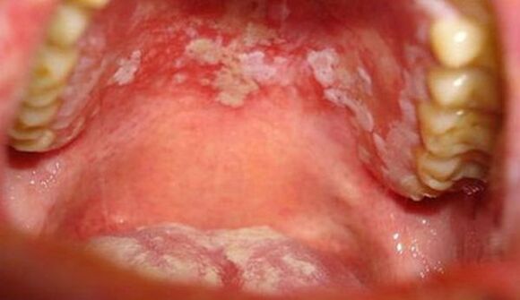 Psoriasis of the mucous membranes