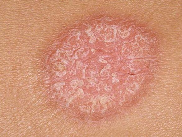 Stationary stage of papules