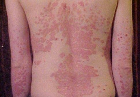 psoriasis symptoms on the back