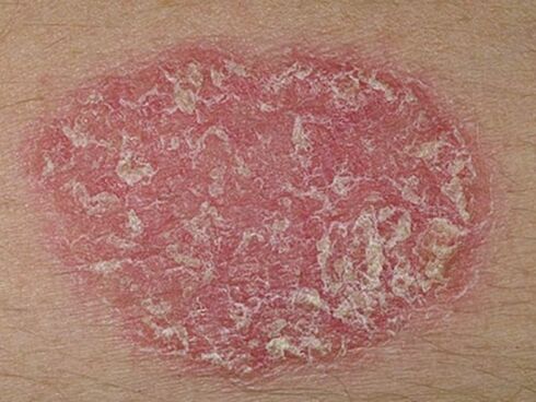 what does psoriasis look like