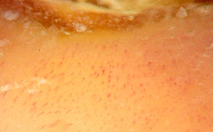Dermatoscopy with 40x magnification confirming psoriasis