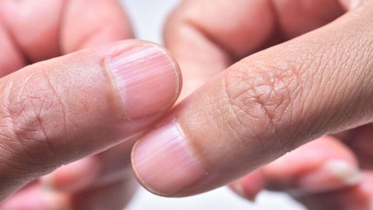 Healthy fingernails
