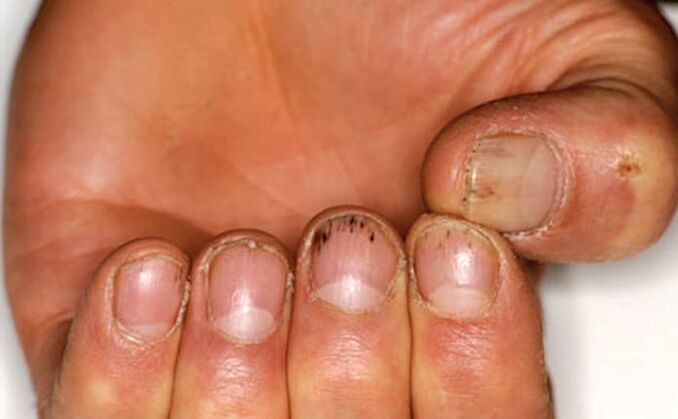 Hemorrhage under the nails with psoriasis