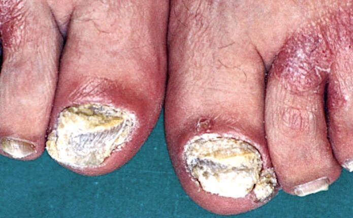 Severe subungual hyperkeratosis and psoriatic plaques on the toes