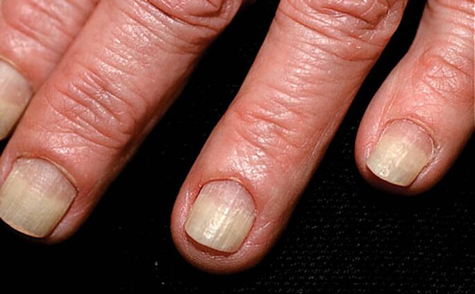 Spread of onycholysis from the edge of the nail to the nail fold