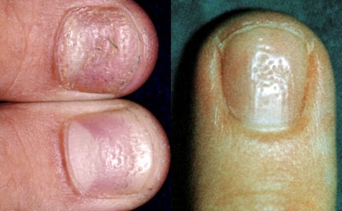 Thimble symptom - multiple depressions on the surface of the nail plate