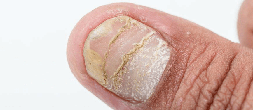 acute form of complications of psoriasis on the nail