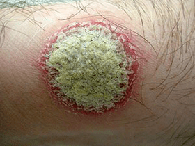 coin rash psoriasis symptom