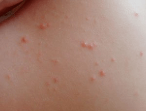 pinpoint rash psoriasis symptom