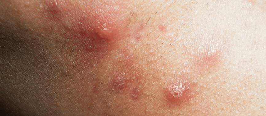 the beginning of the development of guttate psoriasis in childhood