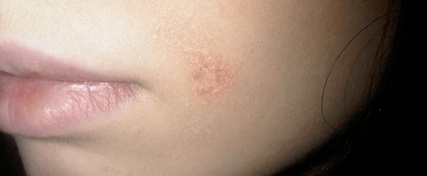 the first symptoms of psoriasis on the face