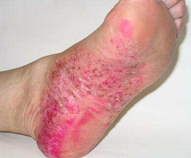 psoriasis on the foot